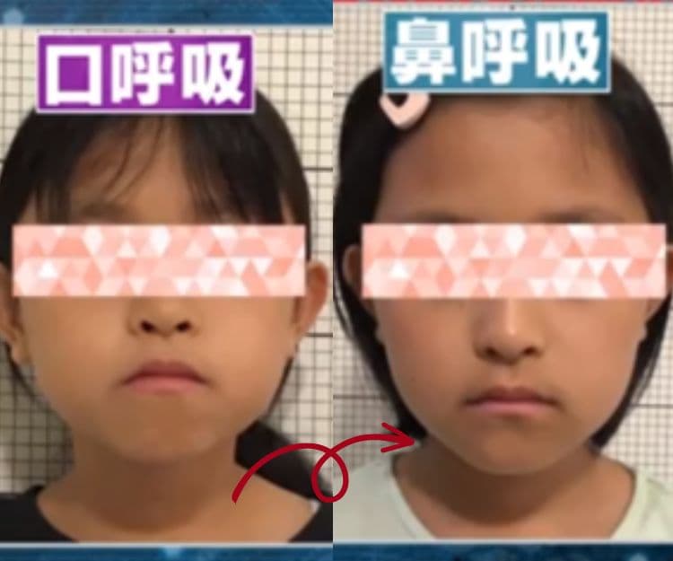 口罩後遺症｜戴口罩常用口呼吸易顯老變馬面？日本醫生教1招還原靚靚臉型