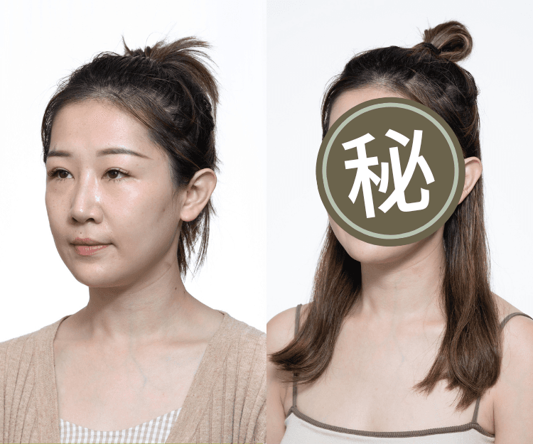 真實用家實測Sculptra®｜PLLA深入肌底  3 個月刺激肌底膠原蛋白自生至 67%¹  全面提升面部輪廓 重拾「原」來自信