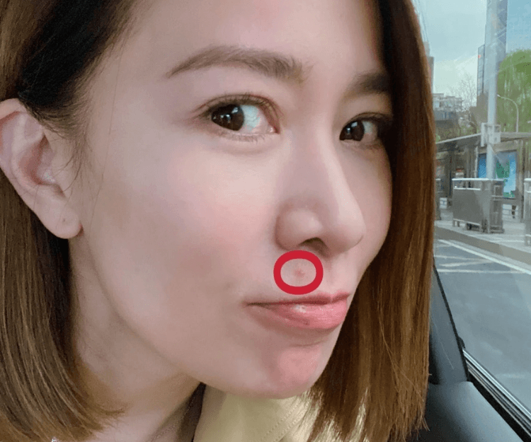 快速去暗瘡印秘訣！一文看清4種暗瘡印＋3大坊間謬誤︰粗鹽混清水有效去角質？ 3大高效去暗瘡印療程推介