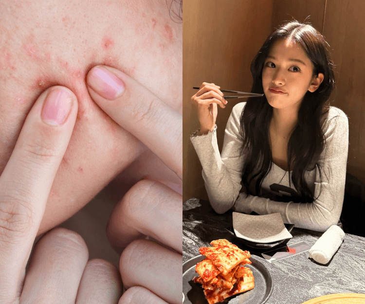 轉季皮膚狂生暗瘡？護膚品已無法改善？了解轉季爆痘成因5大改善暗瘡的飲食 原來圍頸巾、著高領衫都有影響！