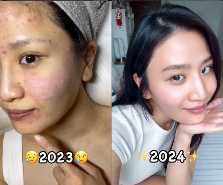 Coffee林芊妤為追B睇中醫後嚴重爆瘡爛面  自爆阿仔1句心情勁低落！想生B要看月經狀況飲食調理 中醫4款備孕食療